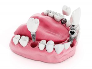 dental-implant-illustration