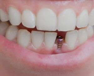 METAL AMALGAM FILLINGS: WHAT YOU NEED TO KNOW