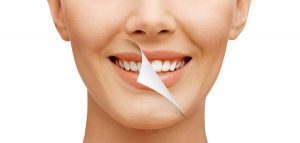porcelain-veneers-teeth-whitening-las-egas-dentist