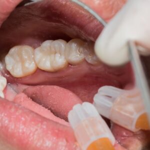 BIGGEST CULPRITS OF DENTAL EROSION
