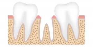 dental bridge