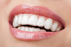 braces