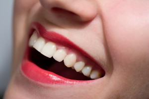 procelain veneers 3