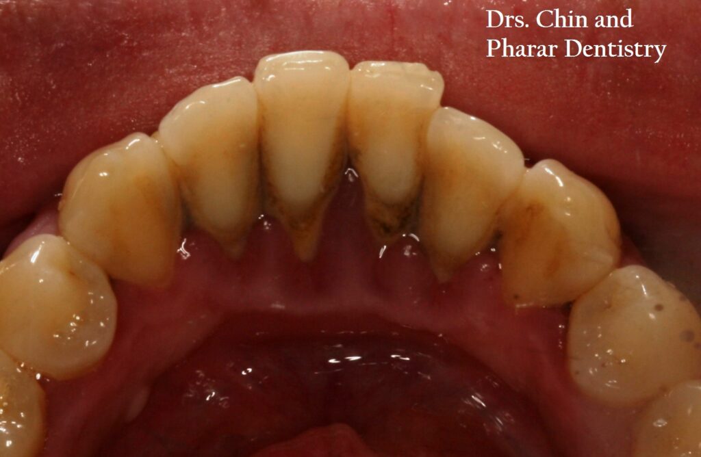 Photo of lower anterior teeth showing dental tartar