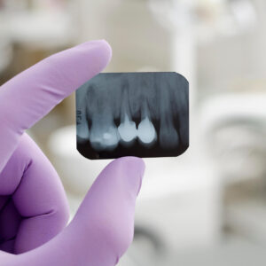 Top Reasons Why Patients Choose Dental Implants