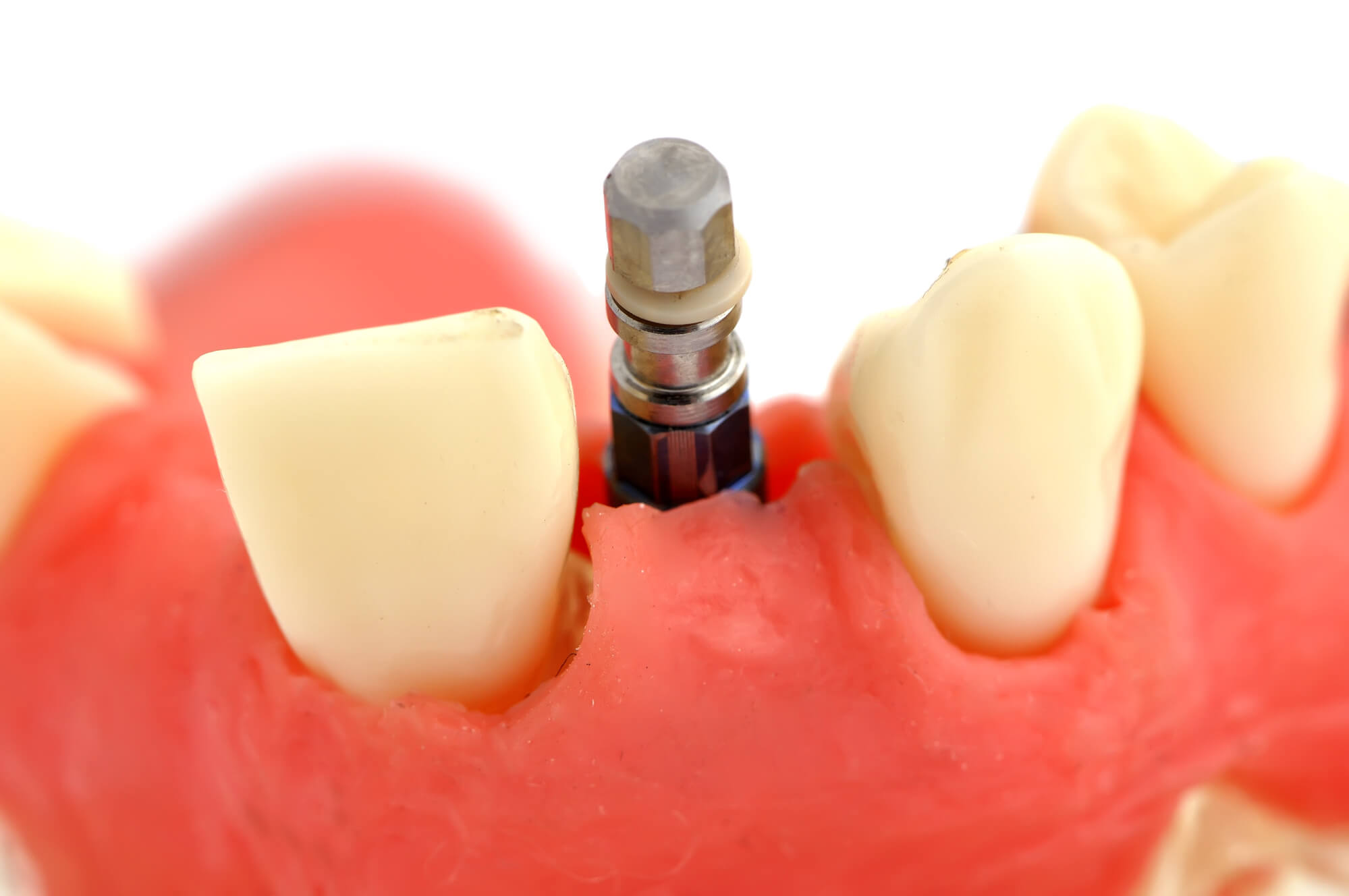 abutment for Las Vegas dental crowns