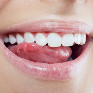 Clear Your Doubts About Teeth Whitening