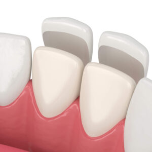 How to Make Your Dental Veneers Last Longer
