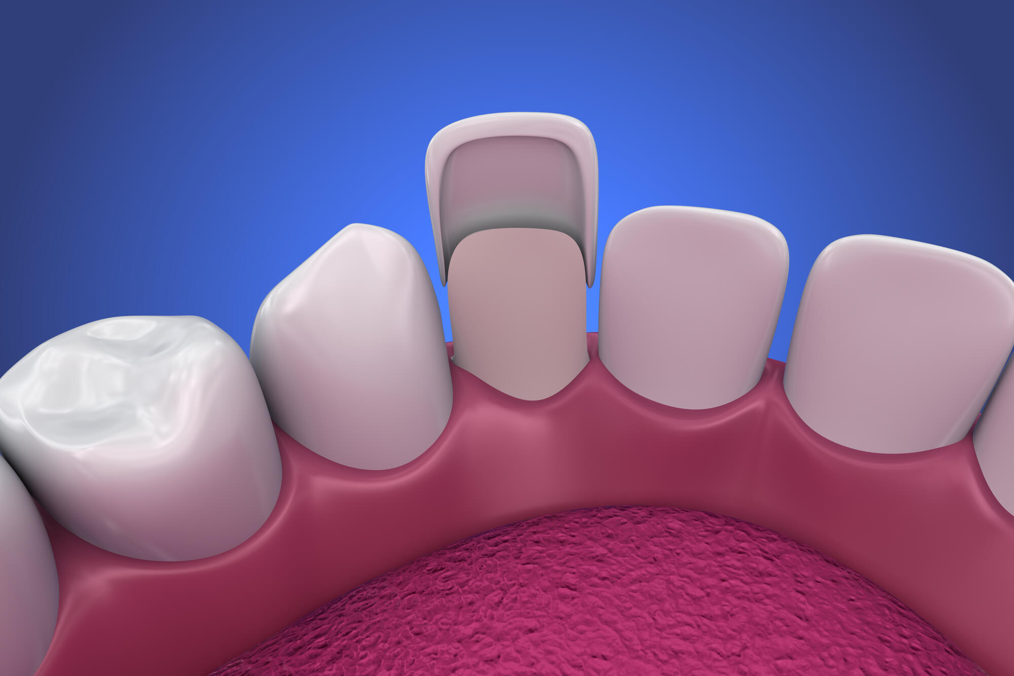 3D image of dental veneers you can get in Las Vegas