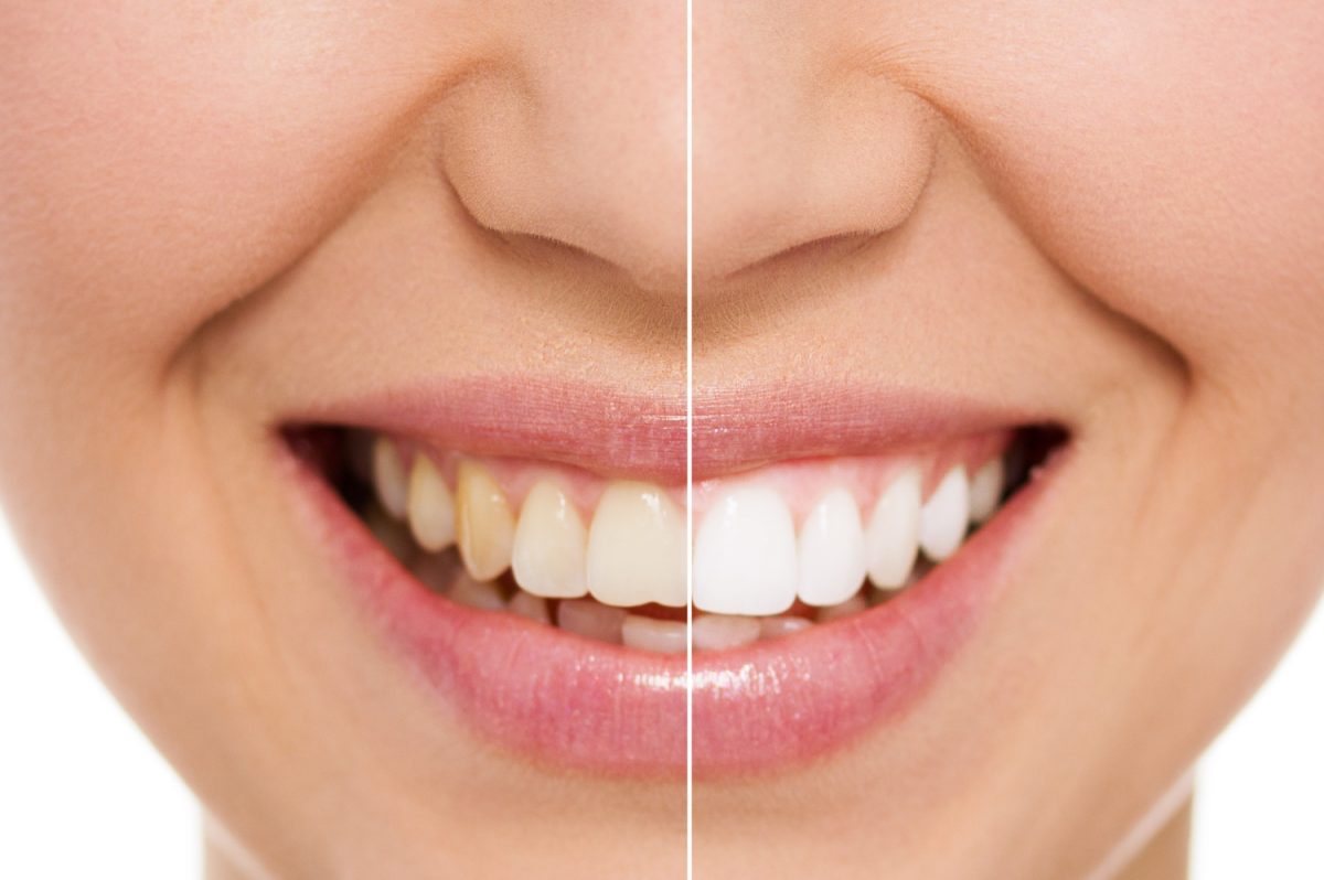 teeth whitening