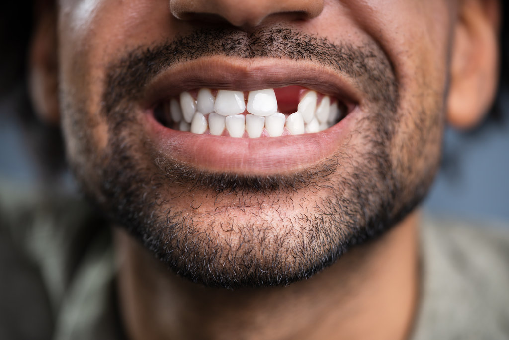 Close Up Photo Of Young Man With Missing Tooth