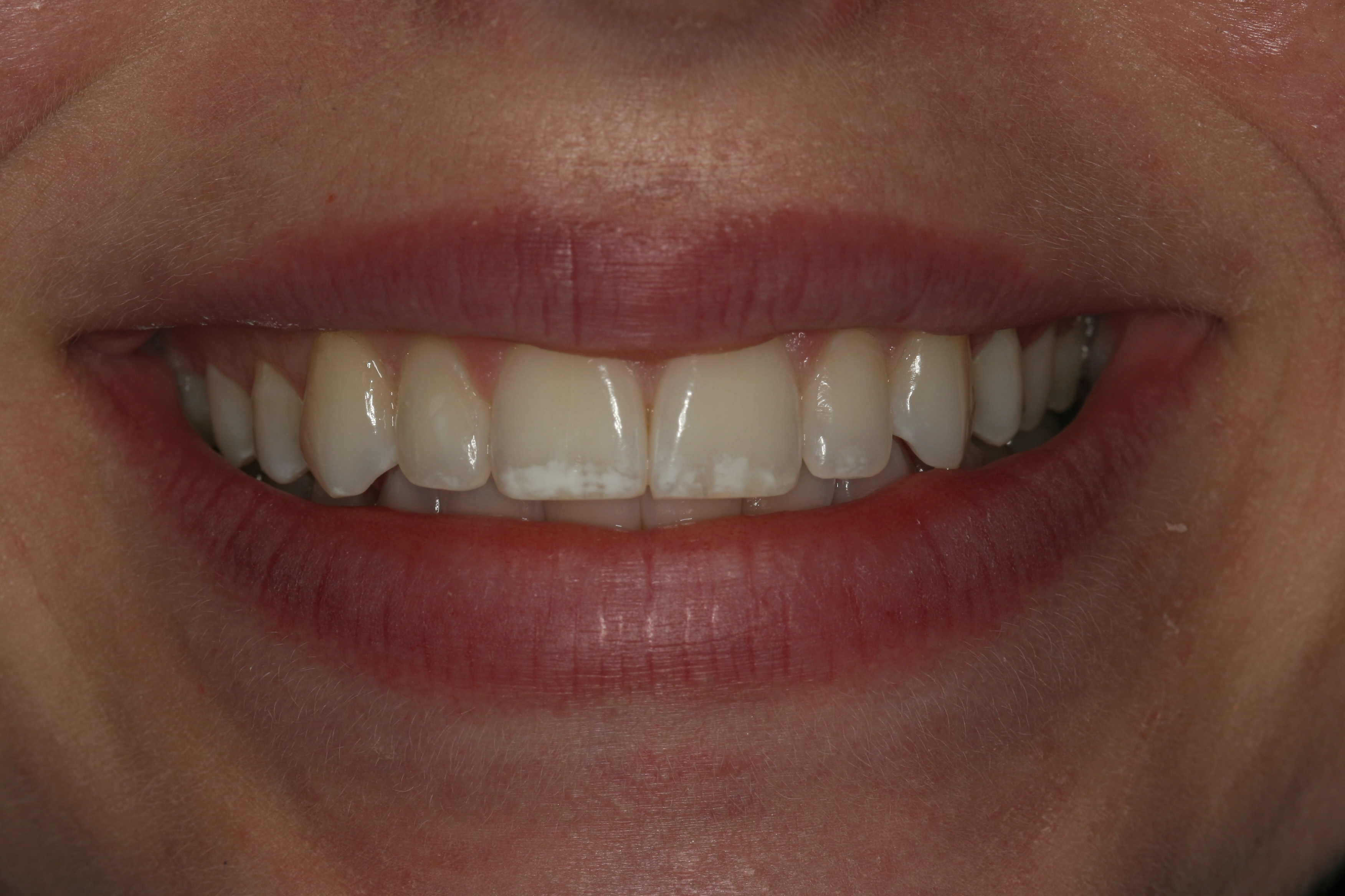 Before cosmetic composite - Family Dentist in Las Vegas