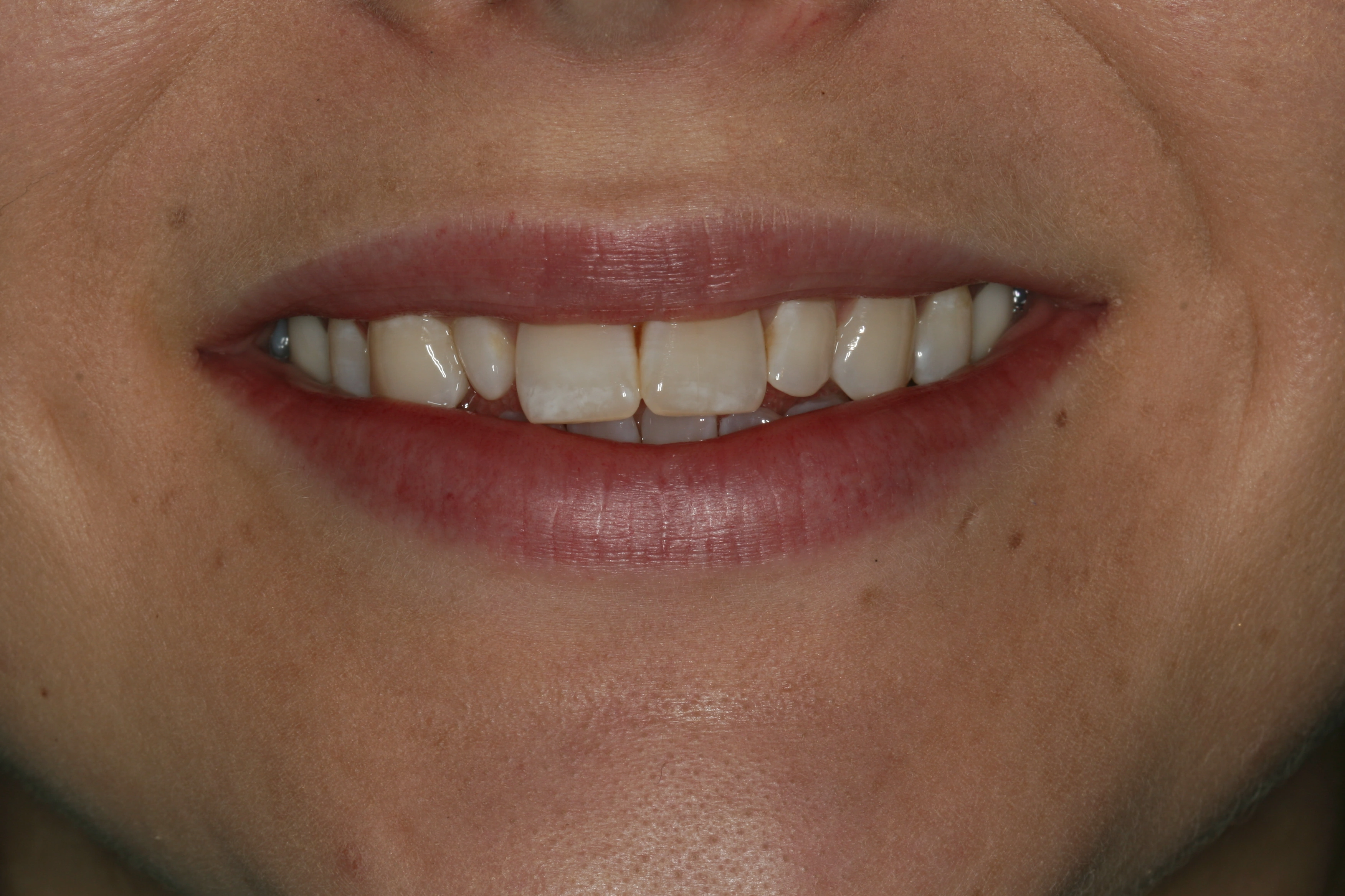 before veneers - Family Dentist in Las Vegas