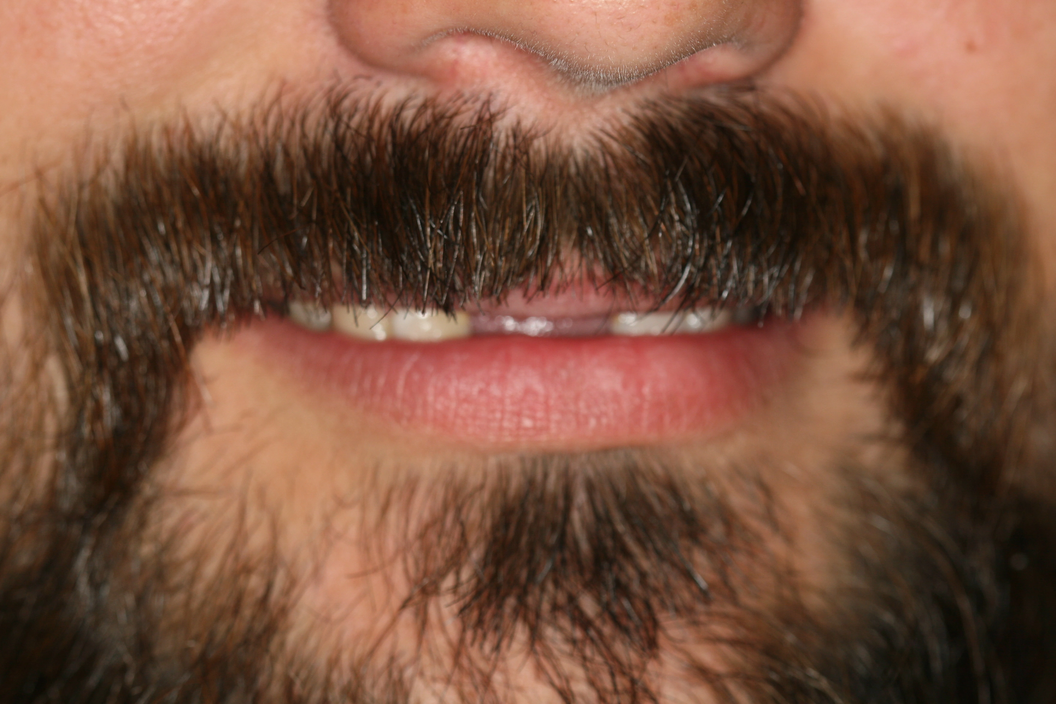 front teeth implants before1 - Family Dentist in Las Vegas